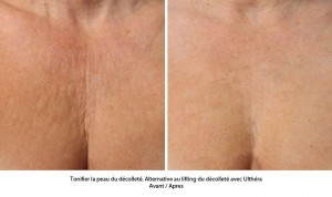 Traitement ultherapy : tonifier la peau du décolleté sans chirurgie