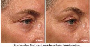 Traitement ultherapy : linfting sans chirurgie